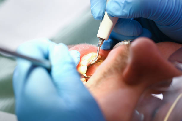 Best Emergency Root Canal Treatment in Tiburon, CA